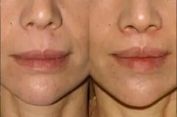 LIP LIFT