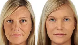 skinboosters