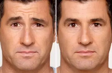 BOTOX